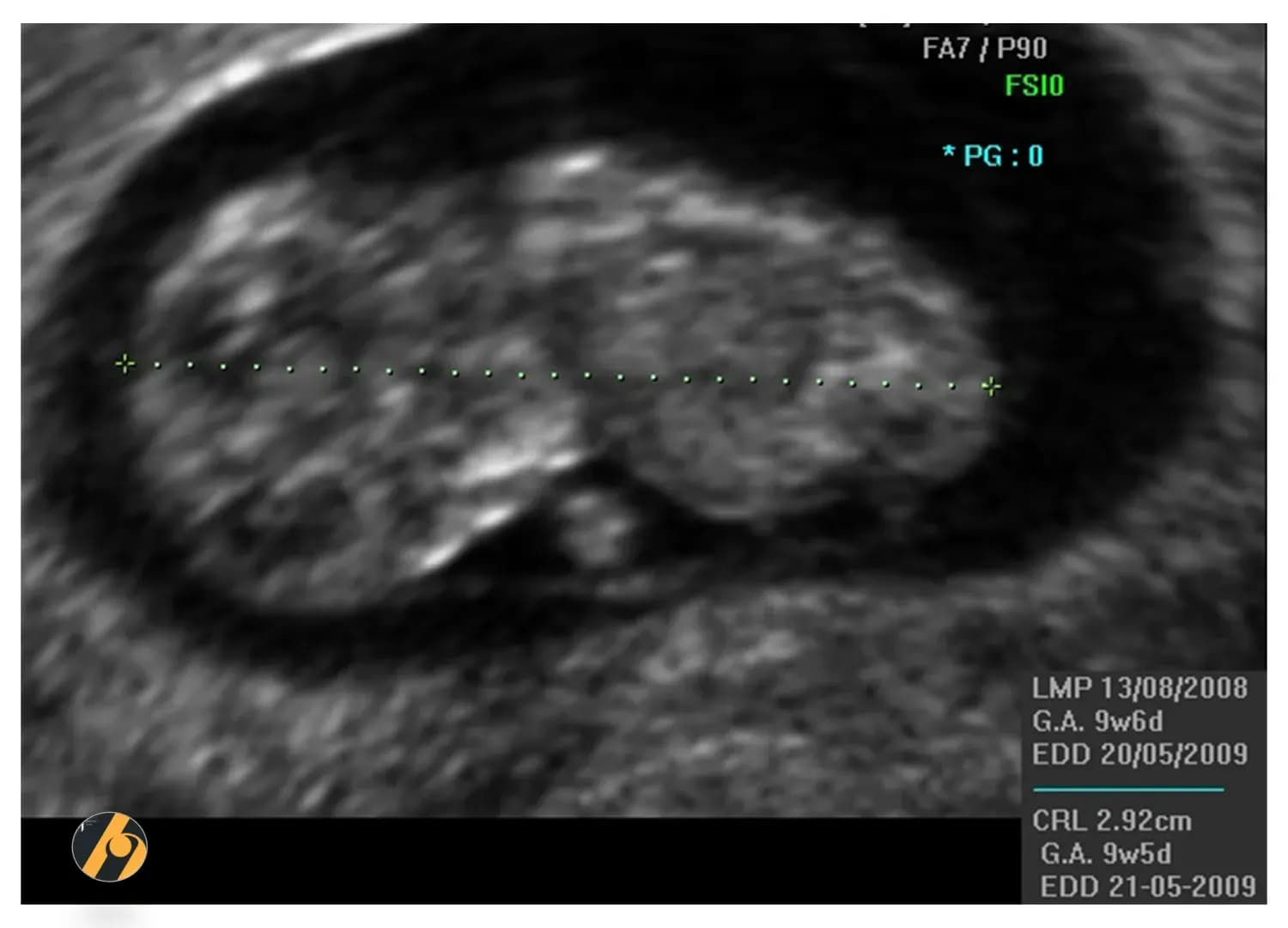 2D ultrazvuk u 10. tjednu trudnoće.