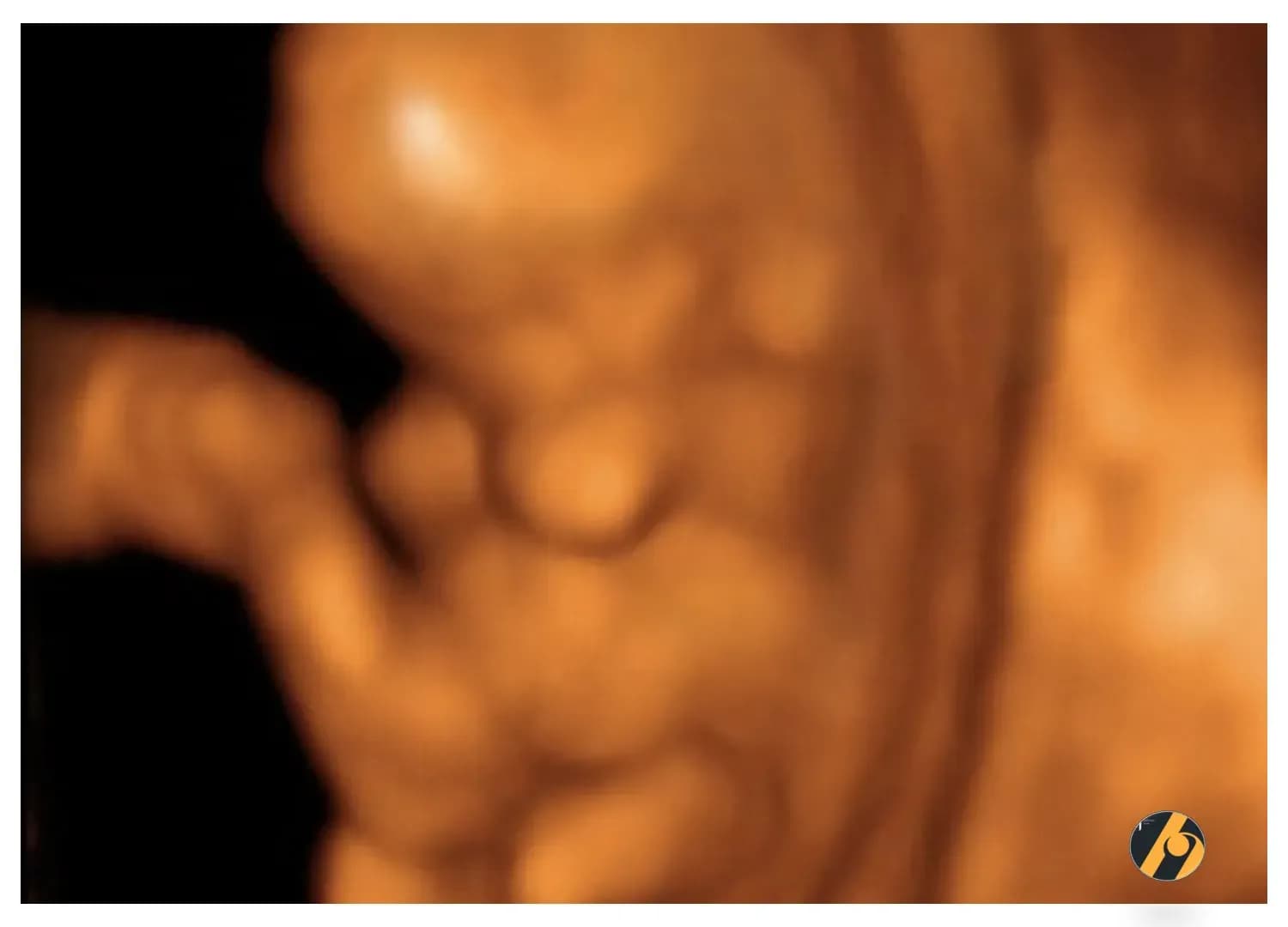 3D rekonstrukcija bebe u 10. tjednu trudnoće..