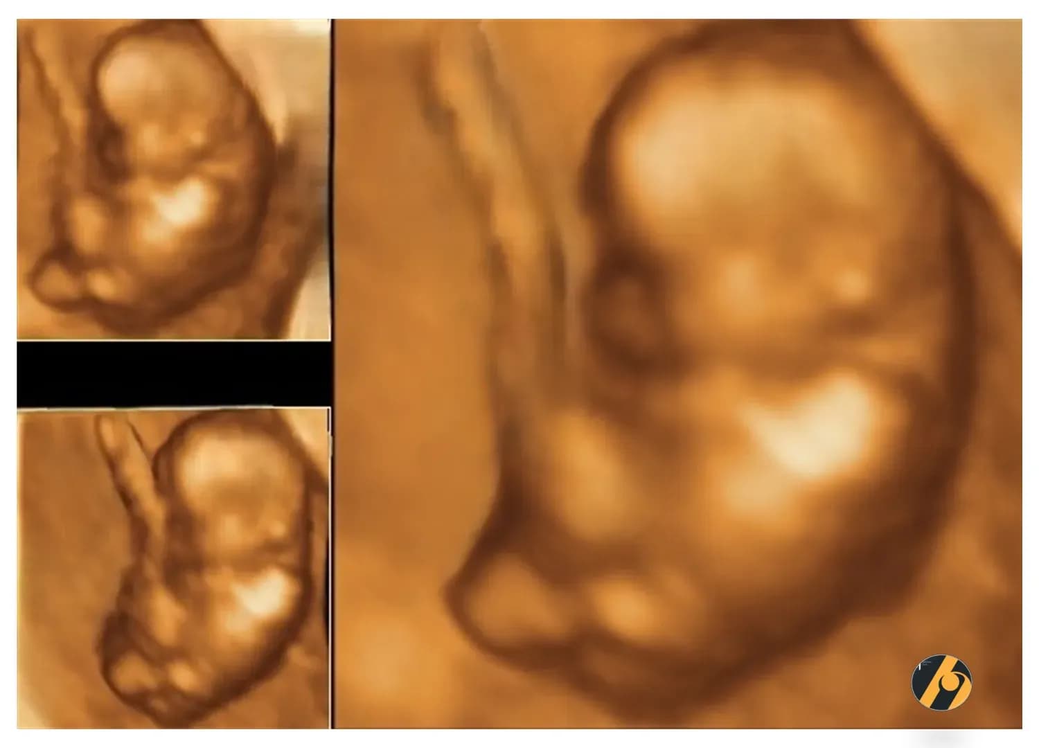 3D ultrazvučna rekonstrukcija bebe u 10. tjednu trudnoće,