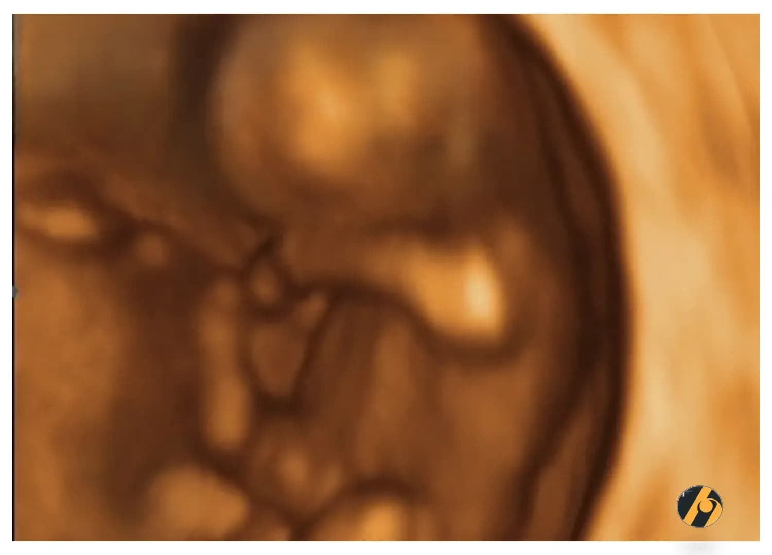 3D ultrazvuk u 10. tjednu trudnoće