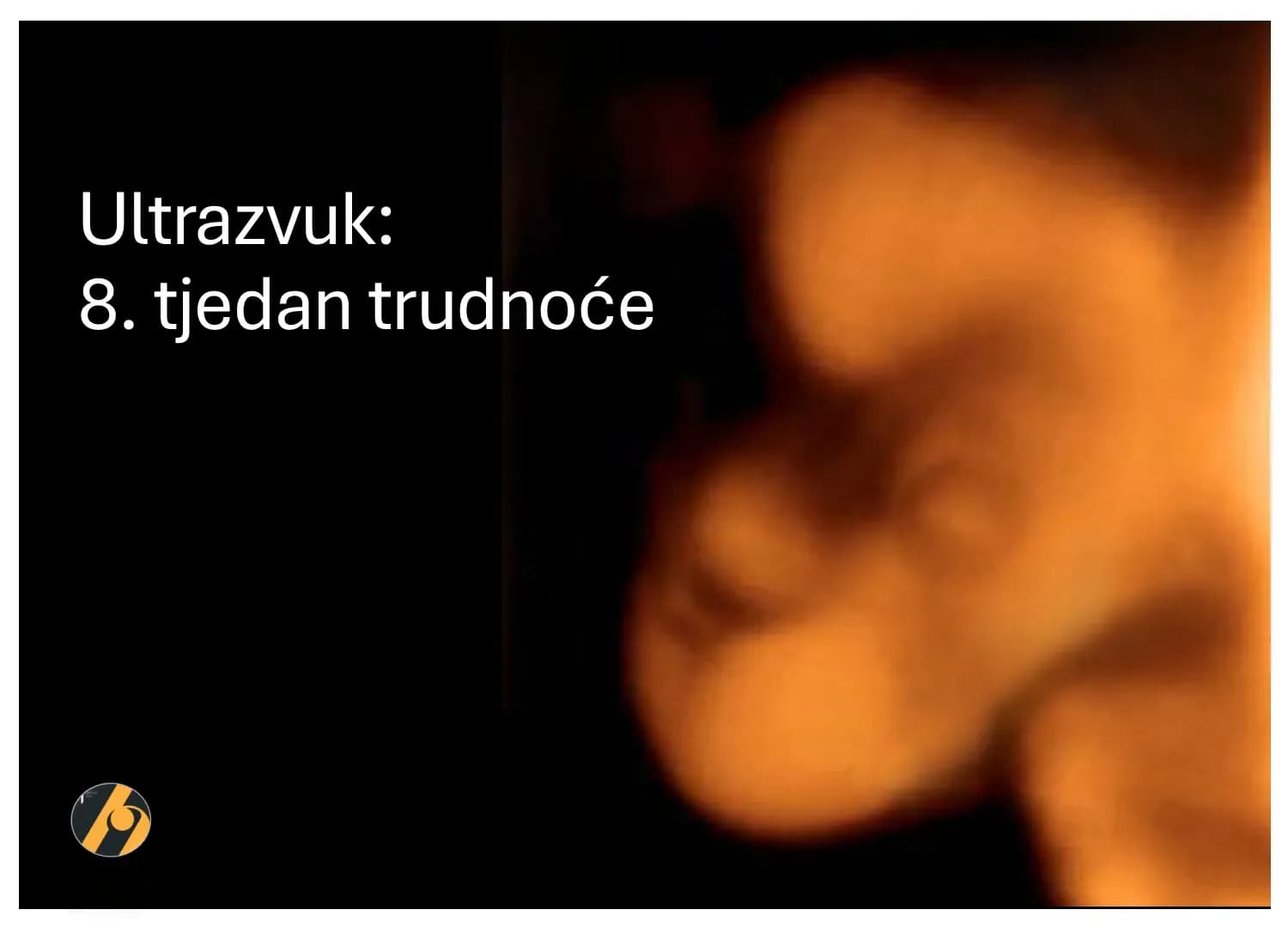 3D ultrazvučni pregled u 8. tjednu trudnoće.