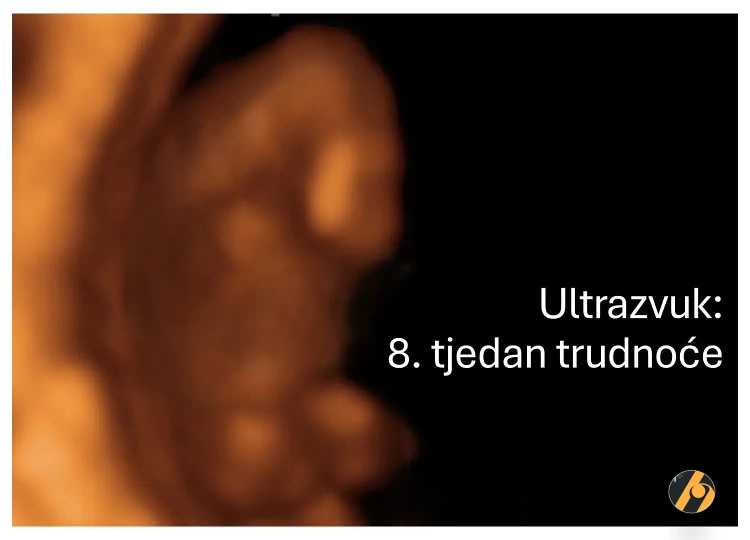 3D ultrazvučni pregled u 8. tjednu trudnoće.