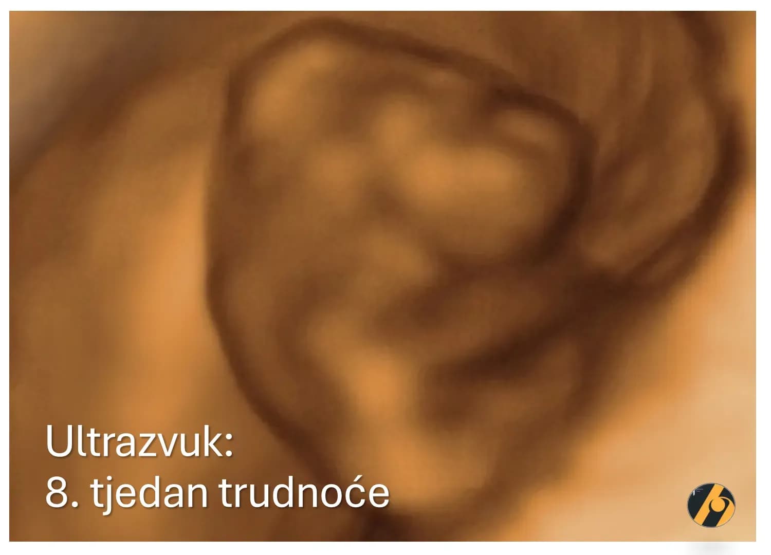3D ultrazvučni pregled u 8. tjednu trudnoće.