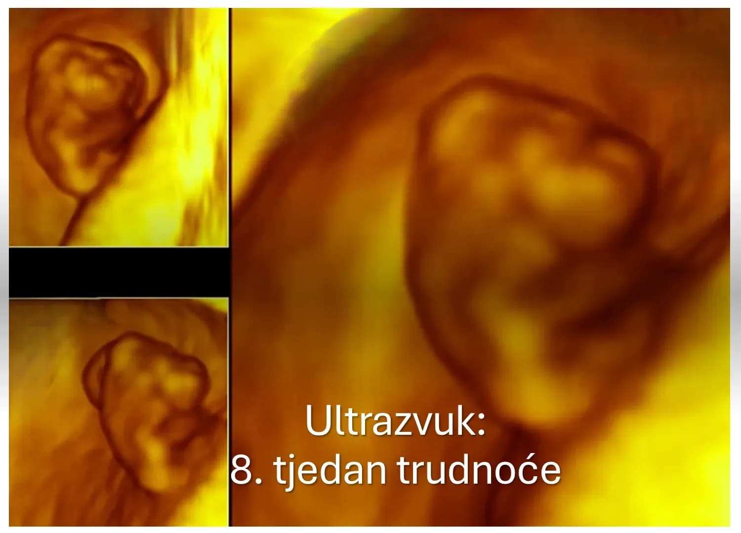 3D ultrazvučni pregled u 8. tjednu trudnoće.