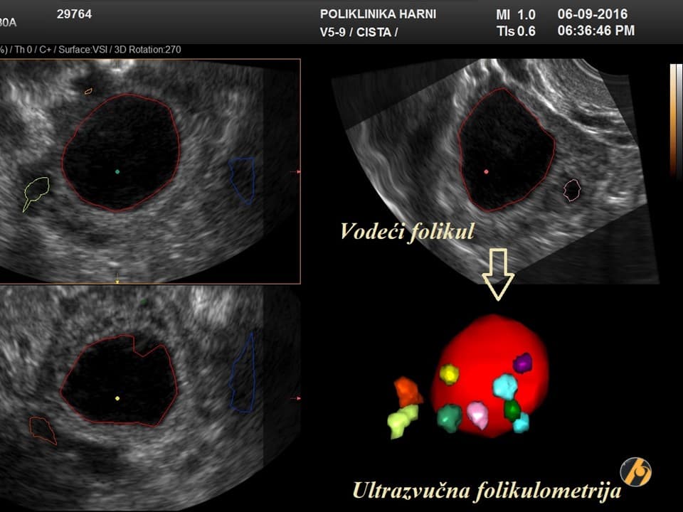 2-vodeci-folikul-kao-crvena-loptica-2-2.jpg
