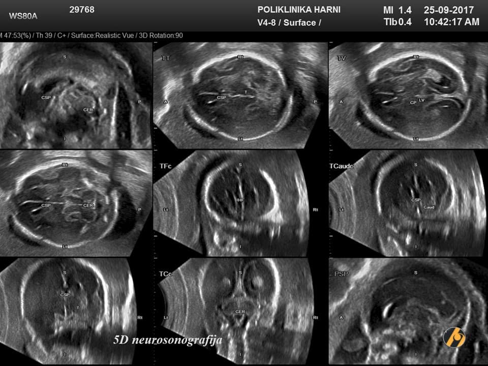 1-5d-neurosonografija-20.jpg