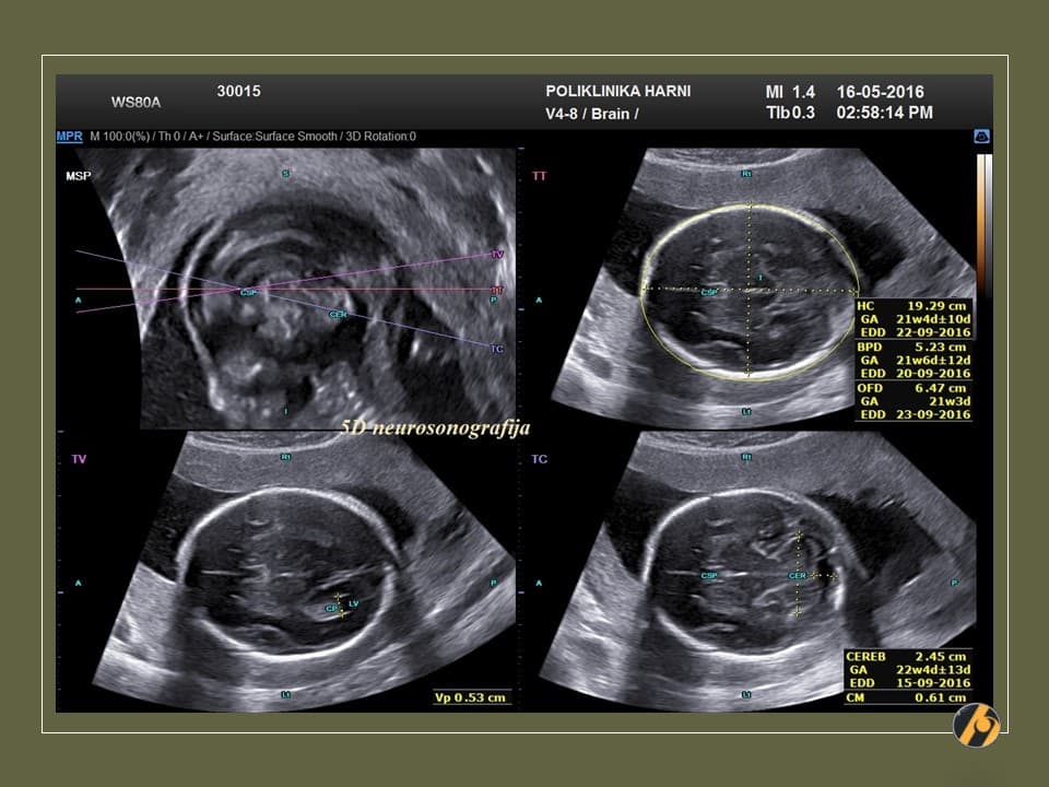 2-5d-neurosonografija-20.jpg