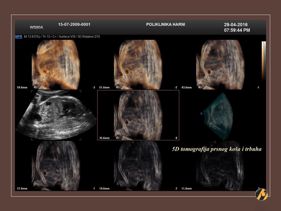 4-uzv-tomografija-21.jpg