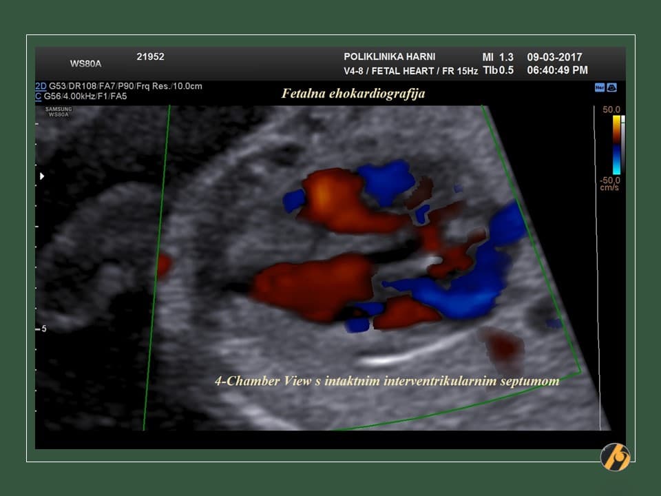 5-fetalna-ehokardiografija-21.jpg