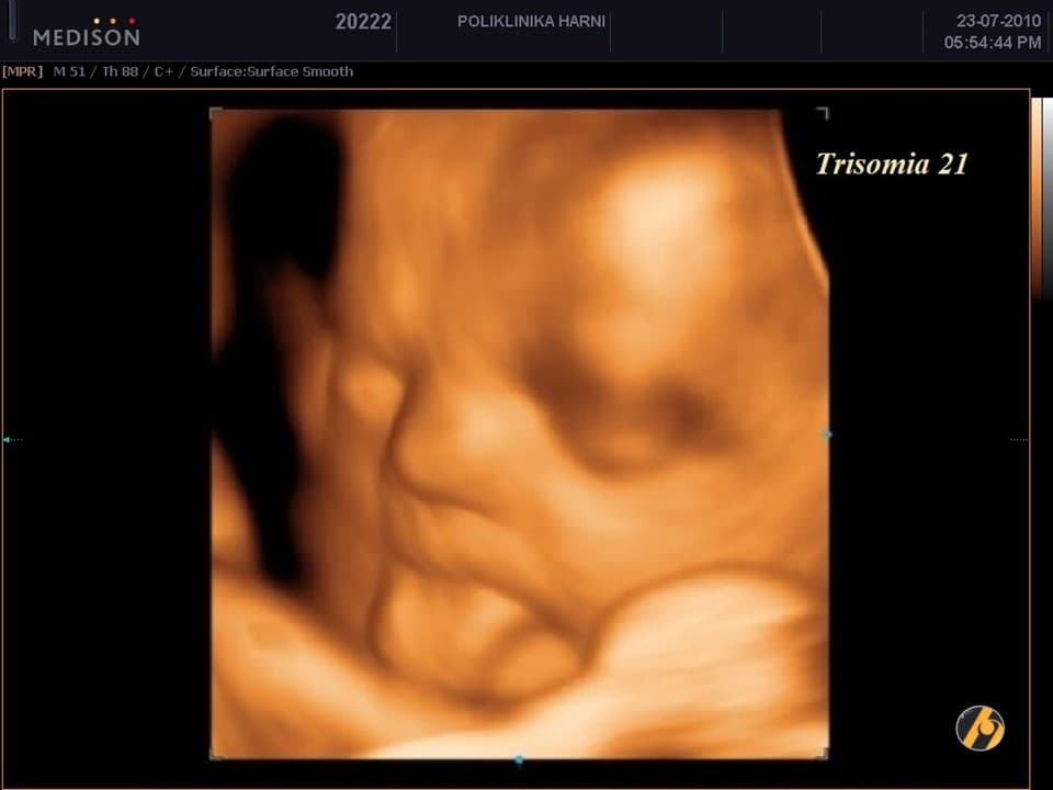 1-trisomia-21-23.jpg