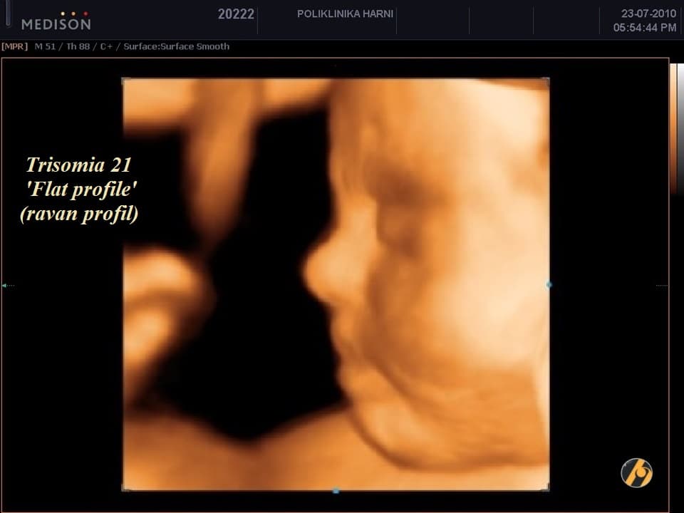 2-flat-provile-trisomia-21-23.jpg