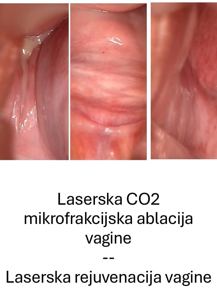 gsm-laserska-co2-mikrofrakcijska-ablacija-vagine.jpg