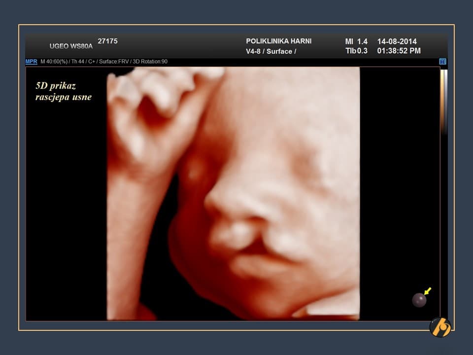 2-uzv-slika-rascjepa-usne-27.jpg