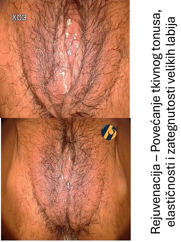 rejuvenacija-velikih-labija.jpg