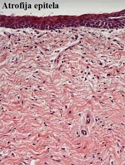 2-atrofija-epitela.jpg