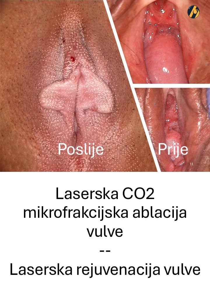 gsm-laserska-co2-mikrofrakcijska-ablacija-vulve2.jpg