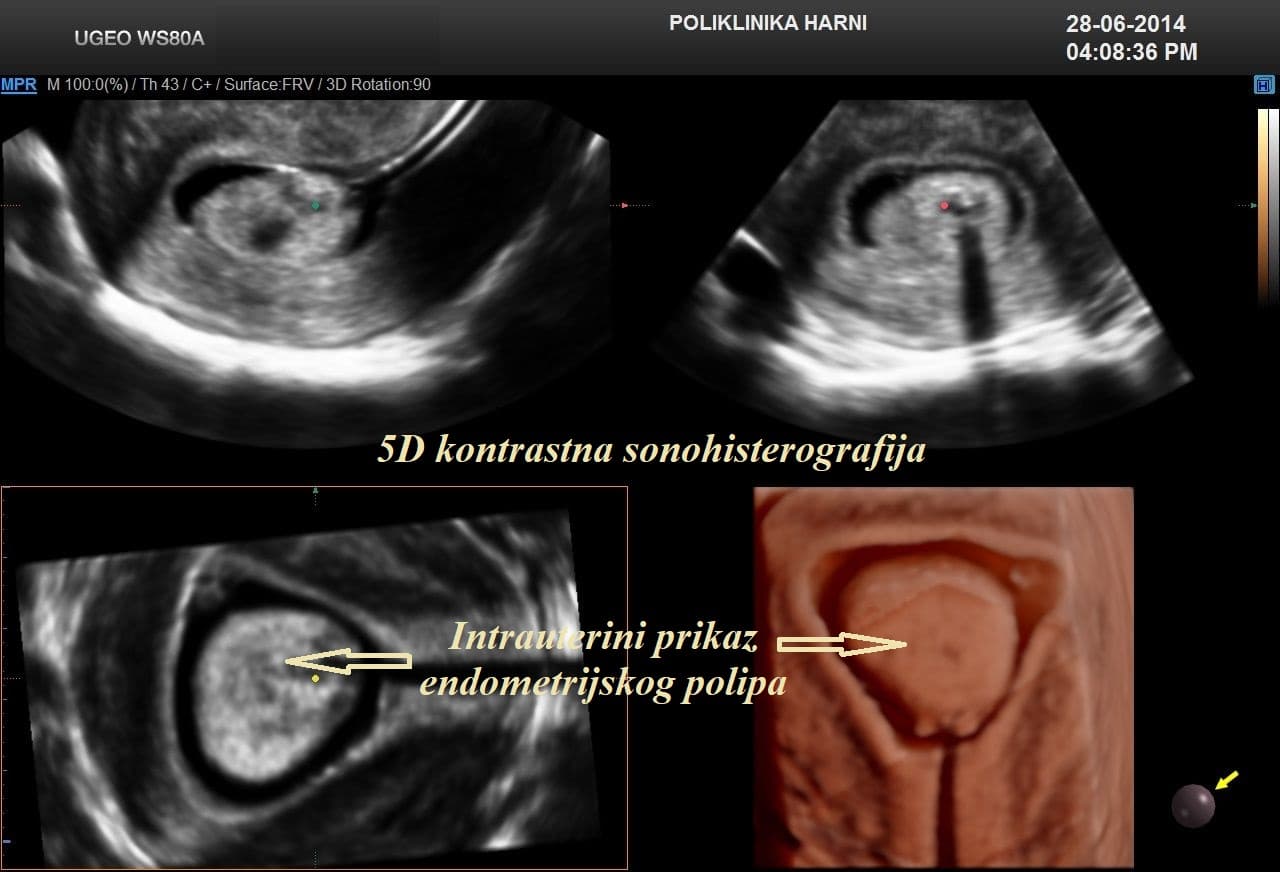 3-sis_intrauterini-nalaz.jpg