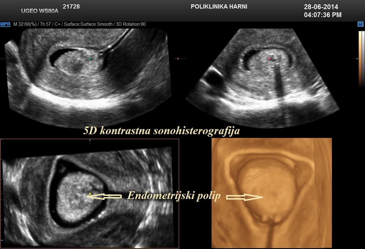 4-multiplanarni-prikaz-intrauterinog-polilpa.jpg