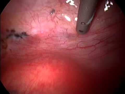 Laserska evaporizacija i mikroablacija u liječenju ginekoloških prekanceroza