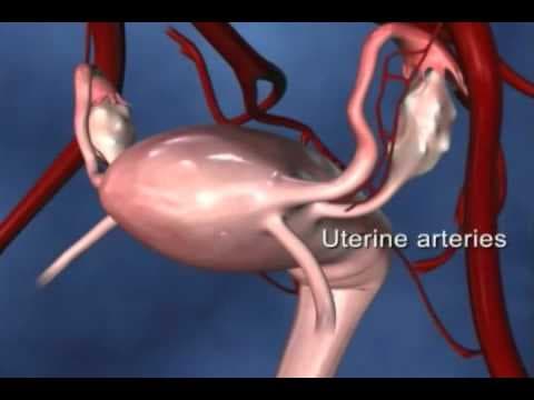 Treba li ostaviti jajnike pri histerektomiji?