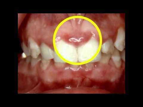 Periodontalne bolesti povećavaju rizik raka dojke