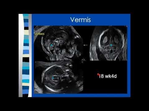 "Znak sjene mozga" ukazuje na fetalnu kraniosinostozu