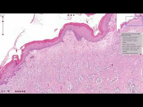 Valjanost PAPA testa s vulve