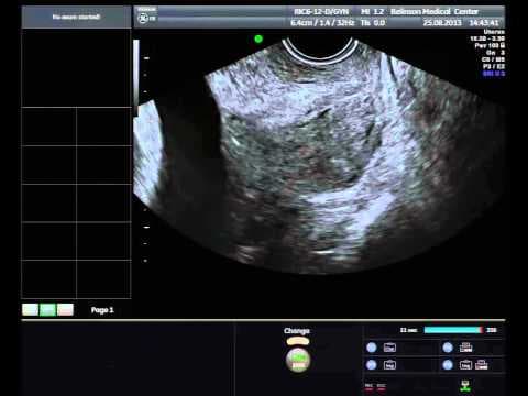 Duljina cerviksa pretkazuje početak porod