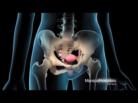 Visoka stopa plodnosti nakon operacije kolorektalne endometrioze