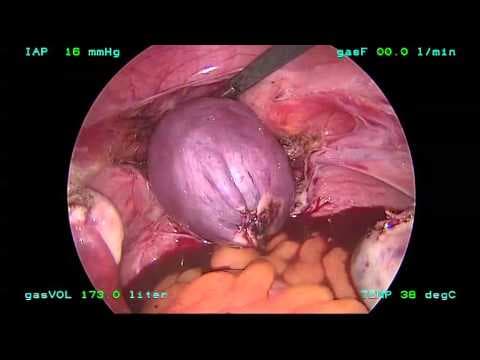 Komplikacije histerektomije u porastu nakon FDA preporuke protiv morselacije