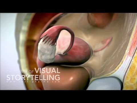 Dienogest - obećani lijek za endometriozu