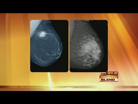 Četvrtina žena s gustim dojkama ima visoki rizik za rak