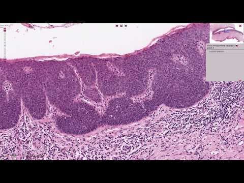 Prekanceroze vulve - VIN