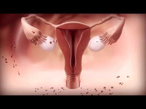 IVF prije operacije zdjelične endometrioze