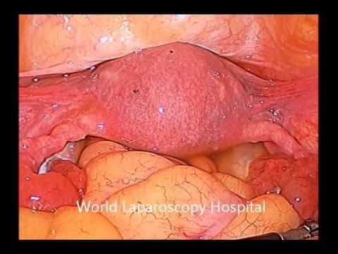 Oštećenja jajovoda