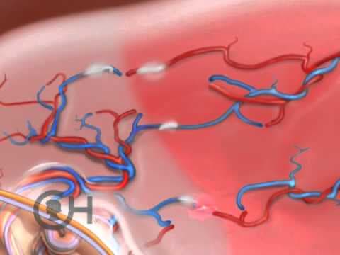 Solomonova tehnika poboljšava ishod feto-fetalnog transfuzijskog sindroma