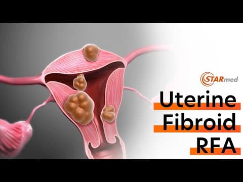 Radiofrekvencijska volumetrijska termalna ablacija siptomatskih mioma