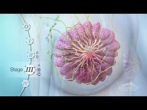 Stadiji karcinoma dojke