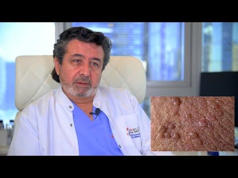 Laser u liječenju vulvarnih lezija i benignih promjena