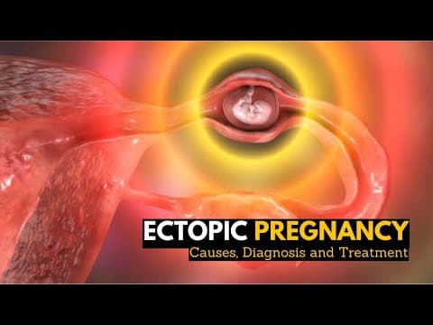 Izvanmaternična trudnoća nakon IVF i MPO