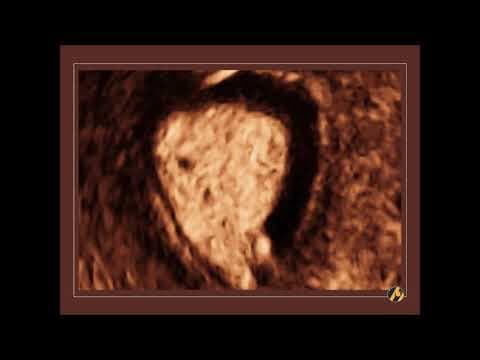 Ultrazvučna dijagnoza mioma