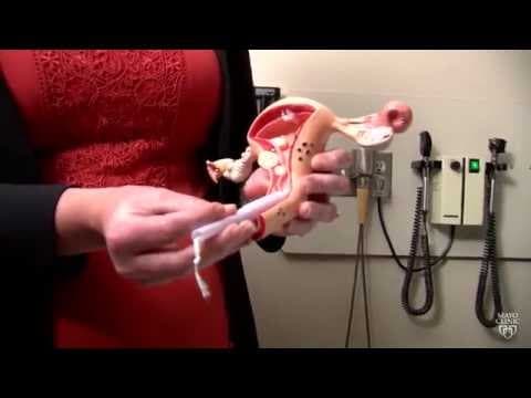 Rak endometrija: pretilost i tjelesna aktivnost