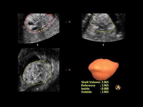 Kontrastni ultrazvuk u ginekologiji