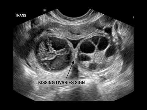 Kissing ovaries kao ultrazvučni znak teške endometrioze