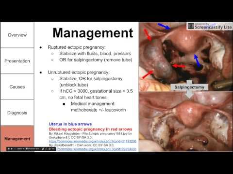 Ektopična trudnoća