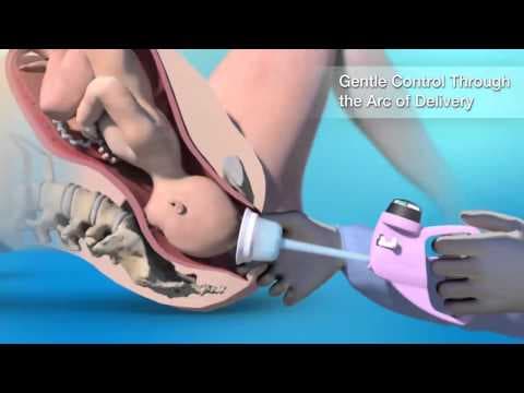 Porod vakumskom ekstrakcijom rjeđi kod žena s prekomjernom težinom