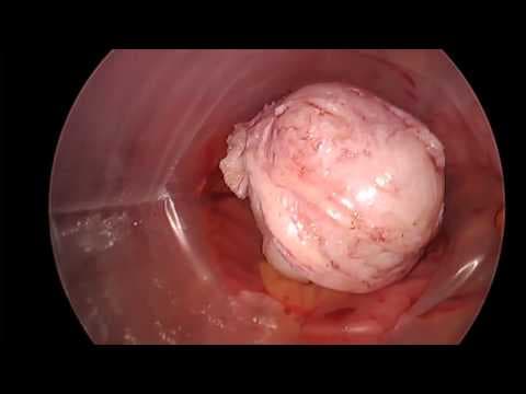 Rizik karcinoma povećan kod laparoskopske morselacije mioma