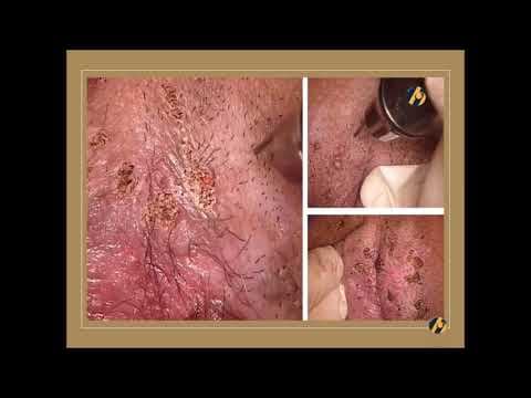 Laserska evaporizacija