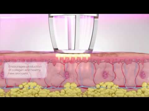 Učinak lasera na tkivo intimnog područja