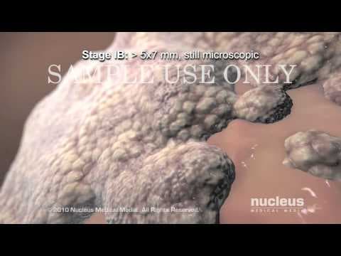 Novootkrivena mutacija gena vodi razvoju ciljane terapije raka cerviksa